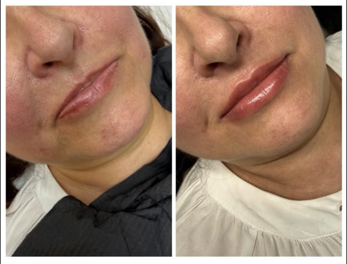 Resultado antes y después — hidratación labial