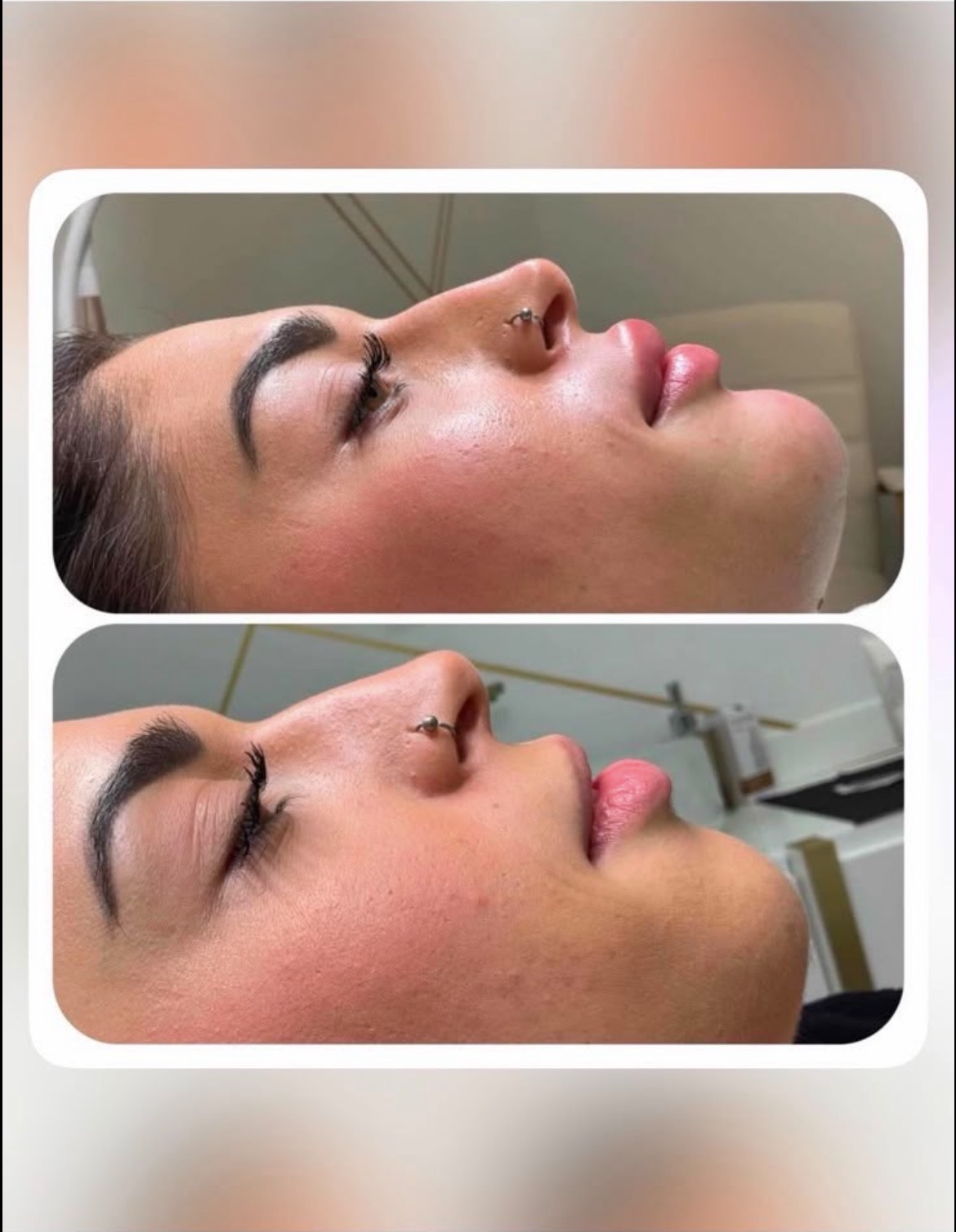 Resultado antes y después — perfil facial