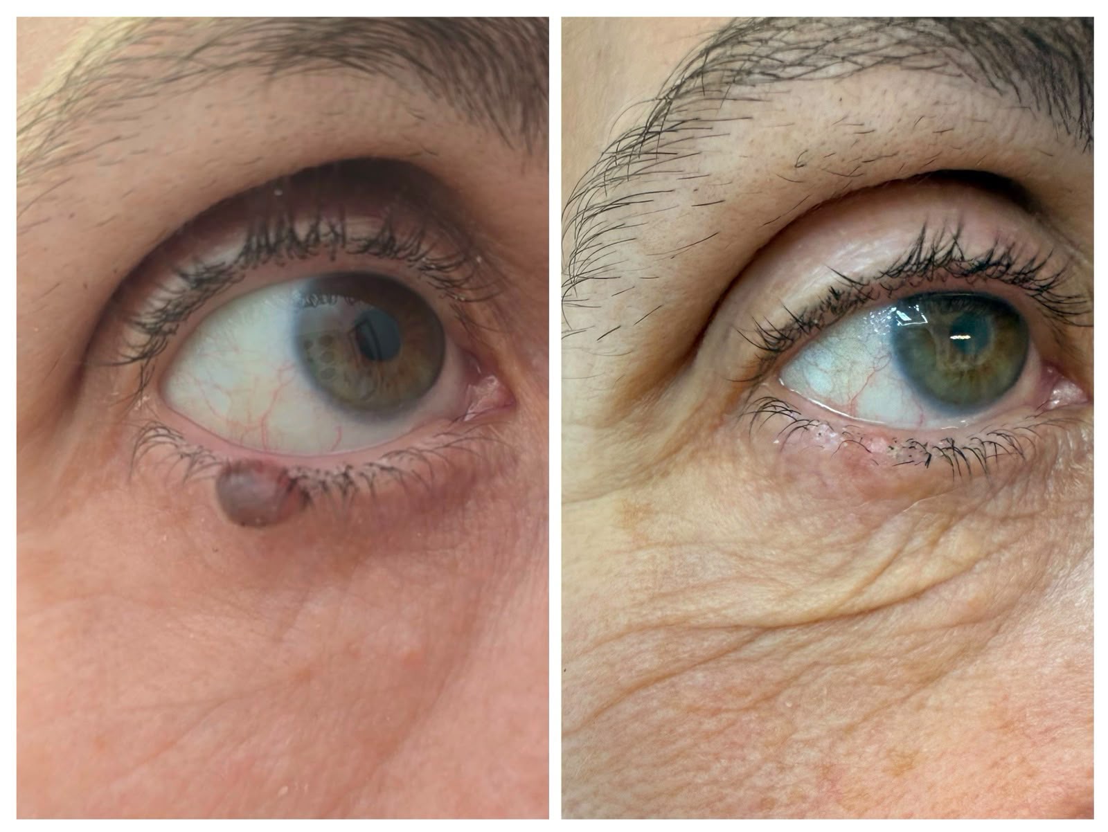 Resultado antes y después — lesión periocular