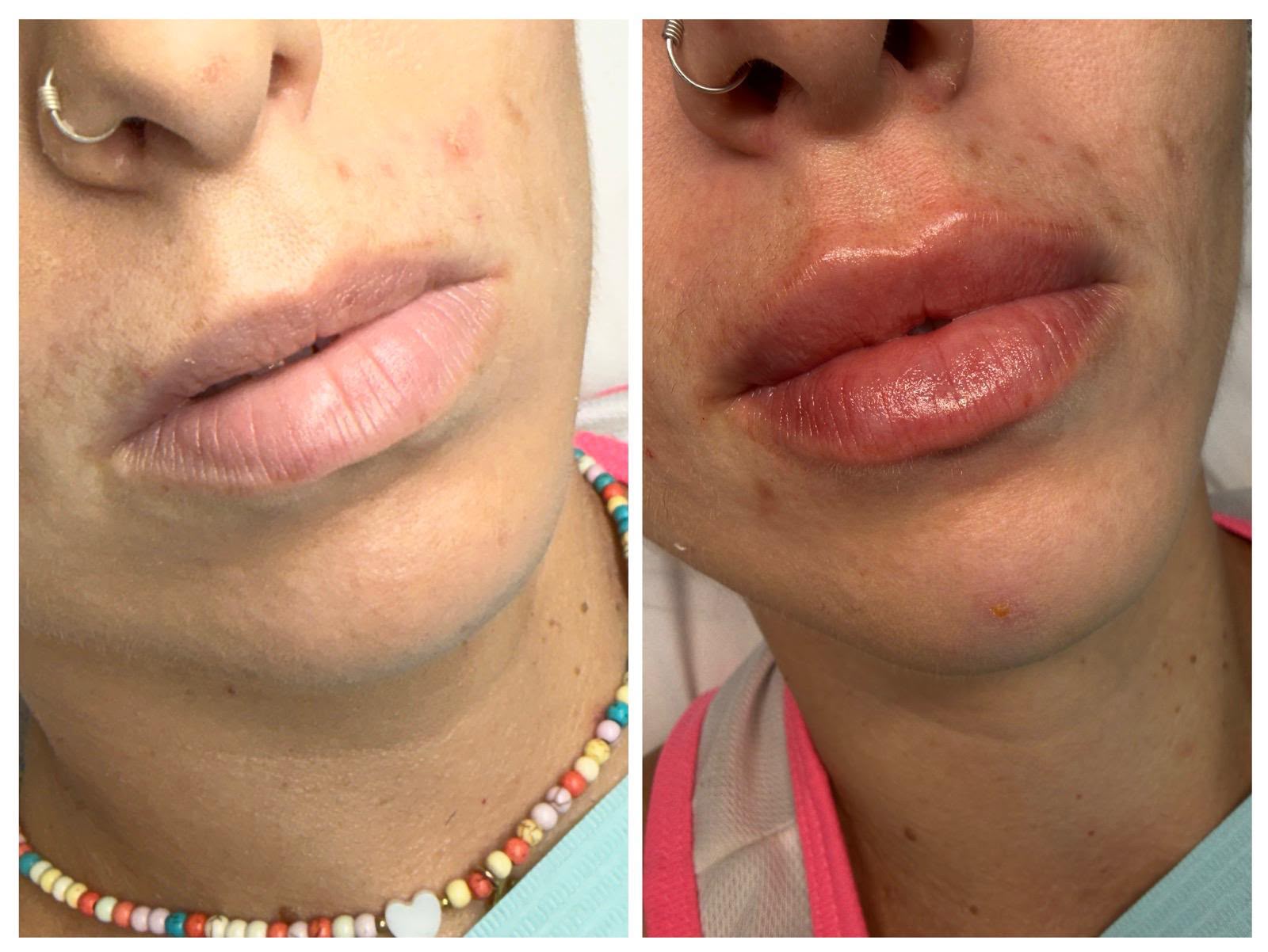Resultado antes y después — volumen labios