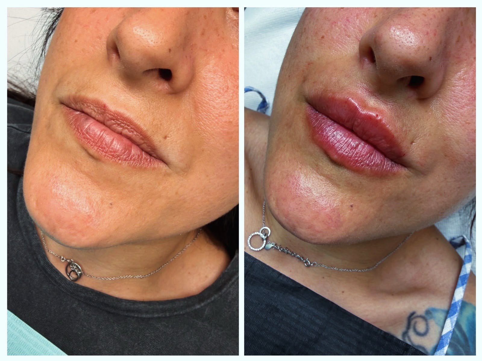 Resultado antes y después — perfilado labial