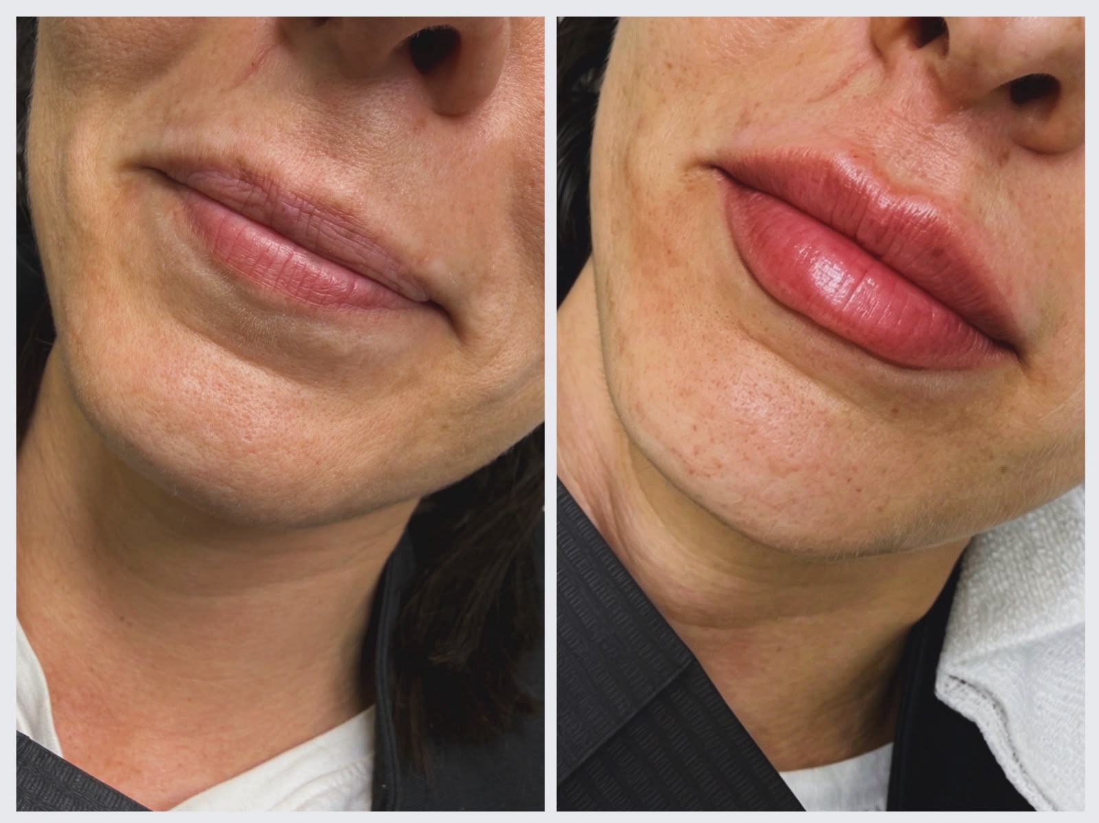 Resultado antes y después — aumento de labios
