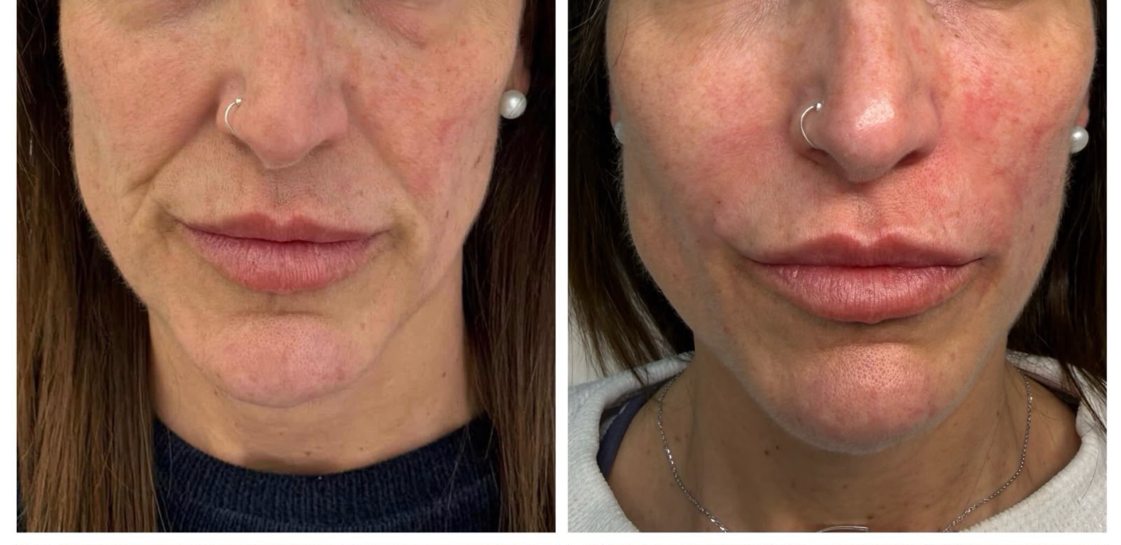 Resultado antes y después — armonización facial
